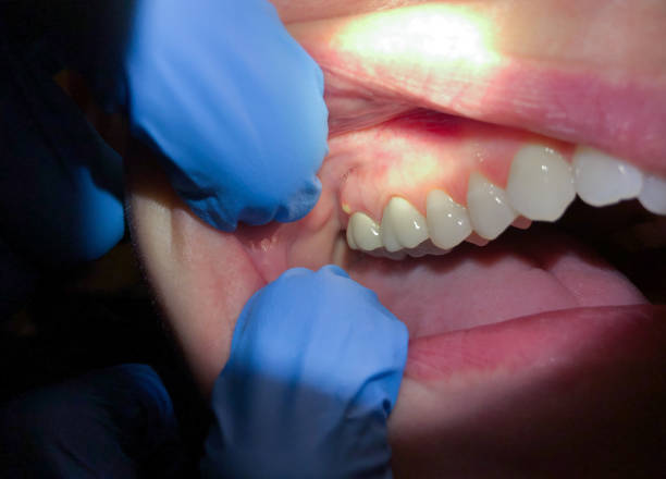 Best Emergency Dental Care for Broken or Chipped Teeth in Mount Olive, MS